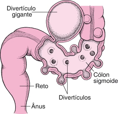 Intestino grosso com divertículos