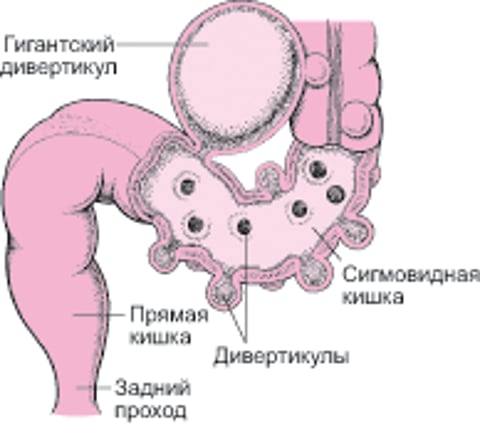 Толстая кишка с дивертикулом