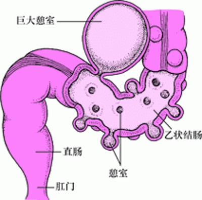 大肠与憩室