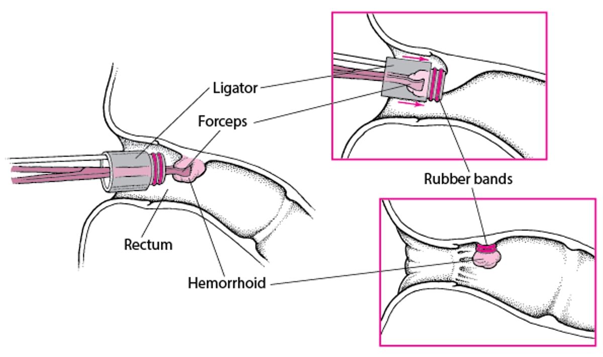 Banding a Hemorrhoid