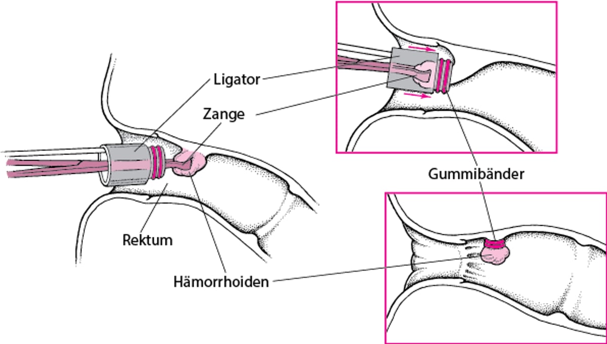 Abbinden einer Hämorrhoide