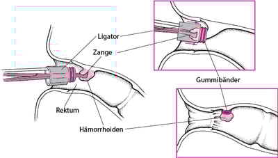 Abbinden einer Hämorrhoide