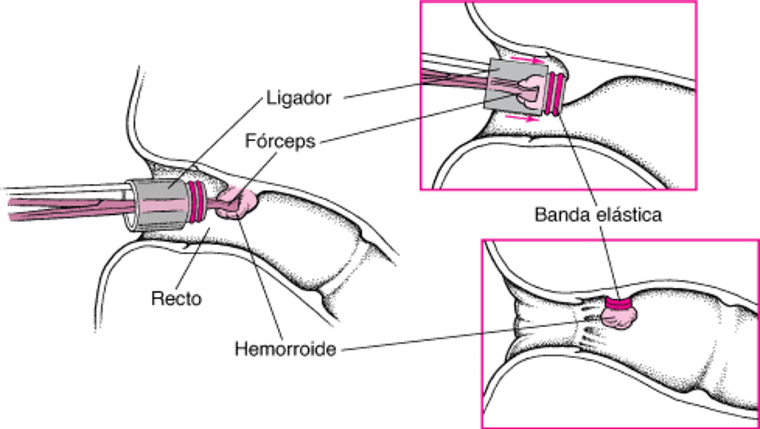 Ligadura de una hemorroide