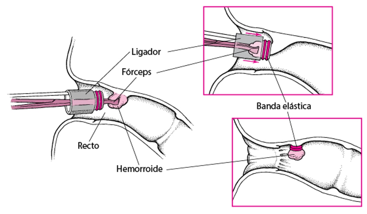 Ligadura de una hemorroide