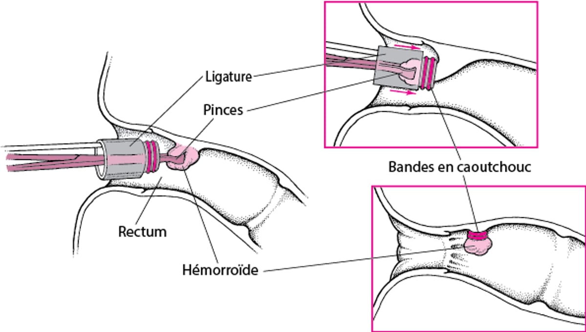 Ligature d’une hémorroïde