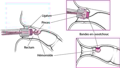 Ligature d’une hémorroïde