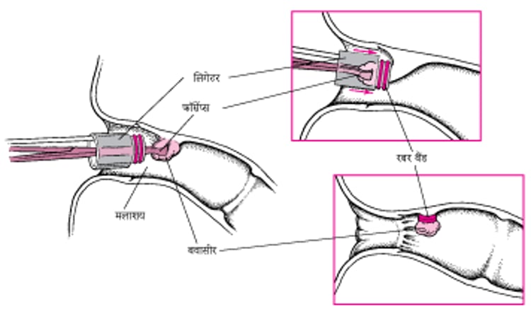 बवासीर को बांधना