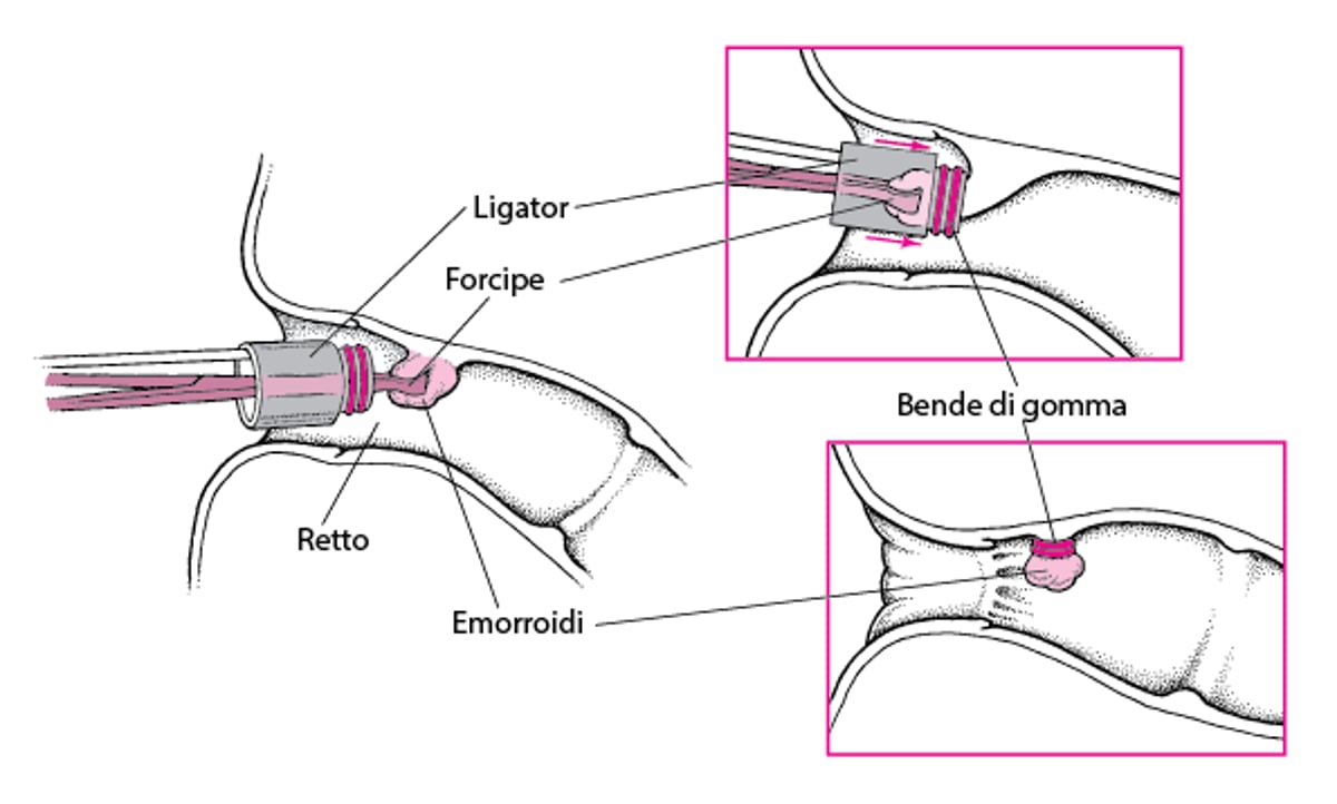 Legatura delle emorroidi