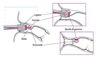 Legatura delle emorroidi