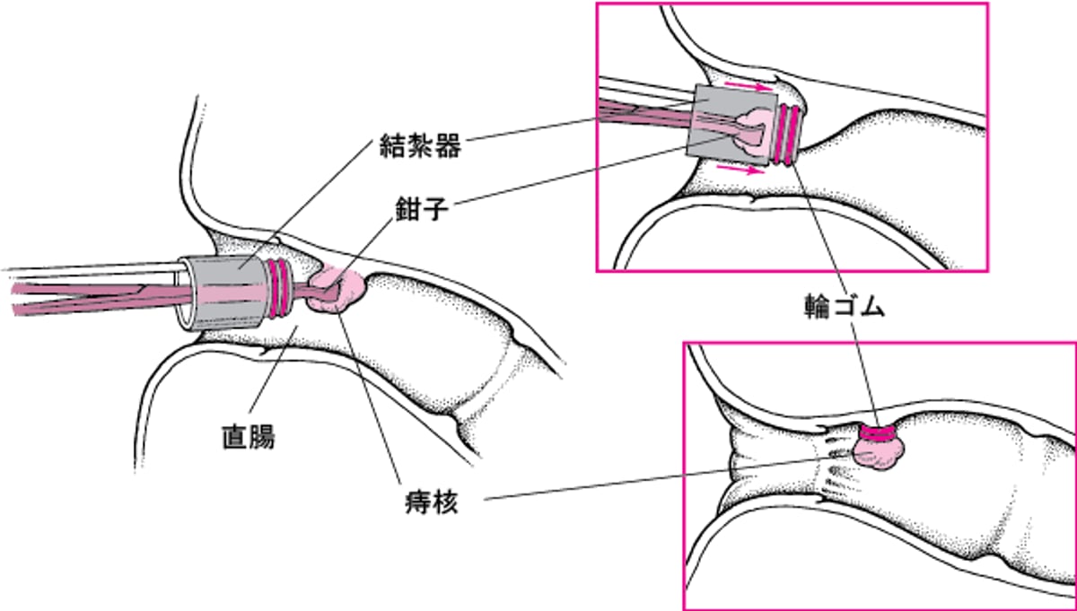 痔核の結紮