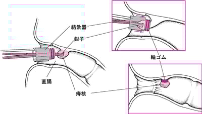 痔核の結紮