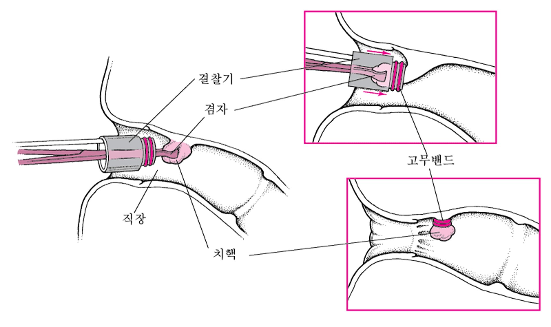 치핵 결찰법