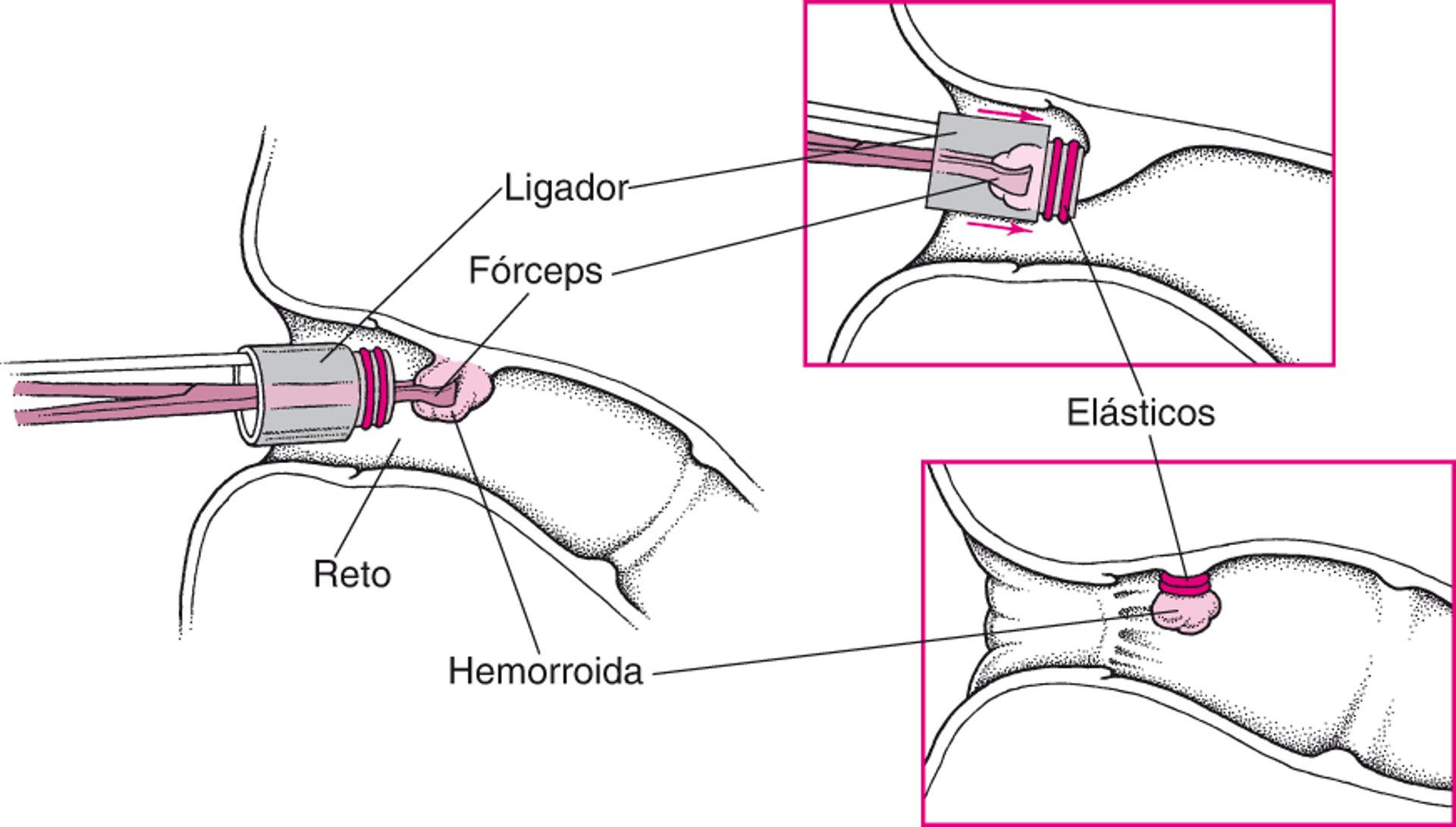 Ligadura de hemorroidas