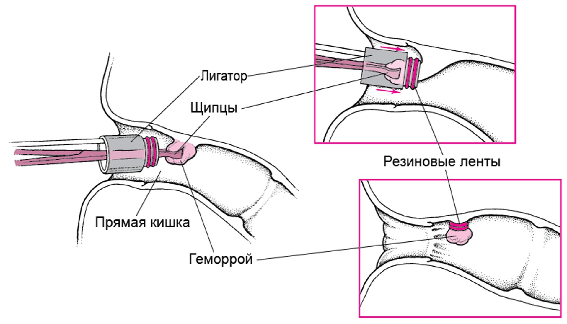 Перевязывание геморроя