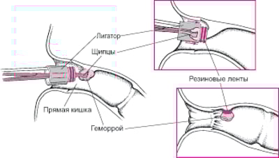 Перевязывание геморроя