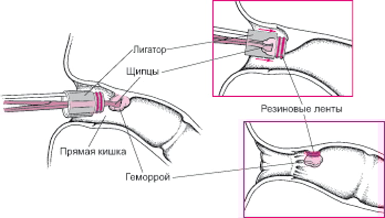 Перевязывание геморроя