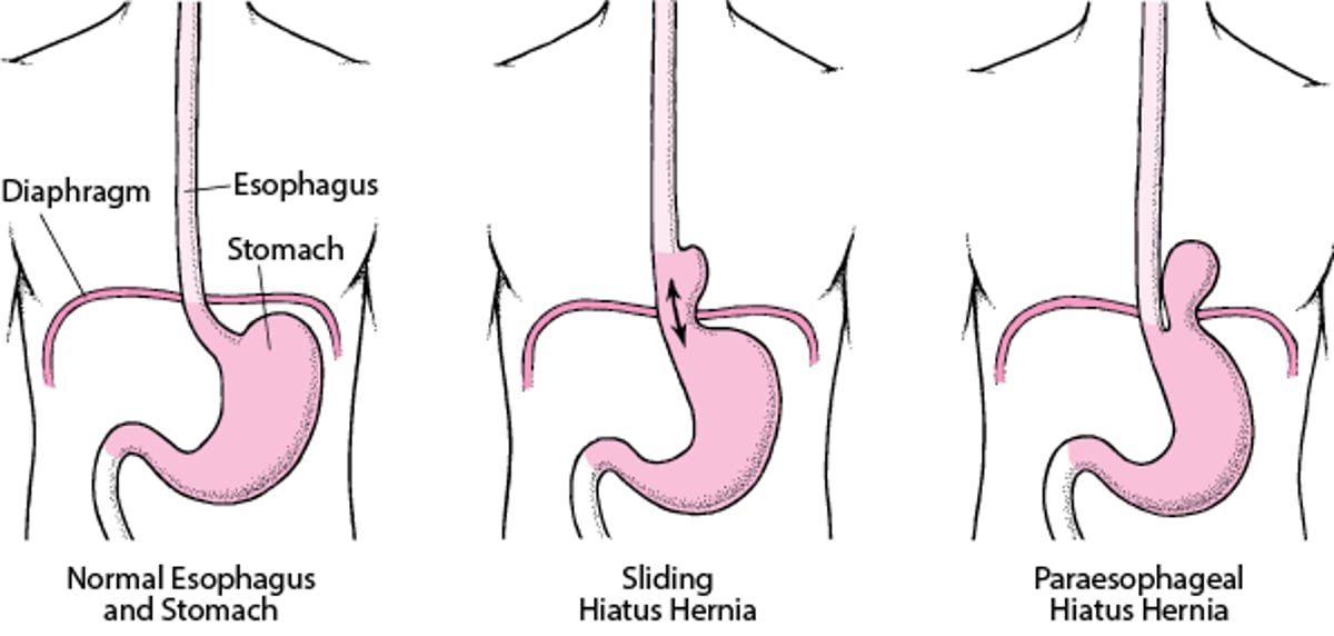 Understanding Hiatus Hernia
