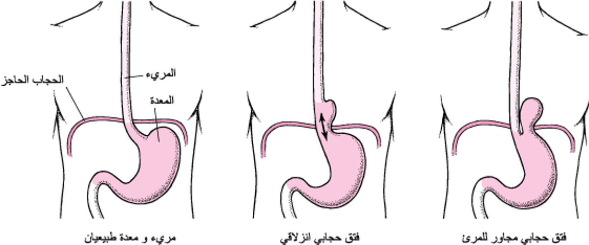 فهم الفتق الحجابي