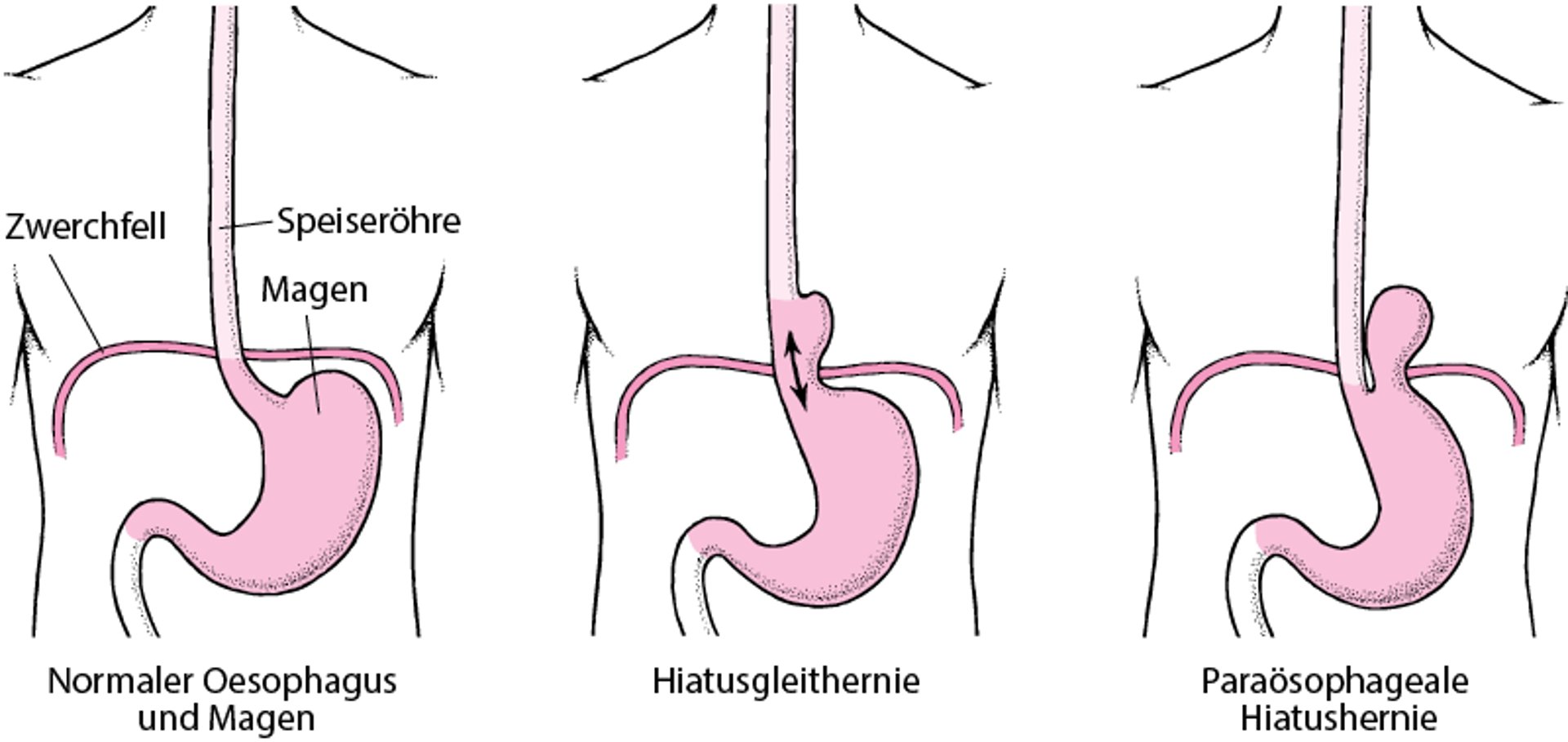 Hiatushernie verstehen