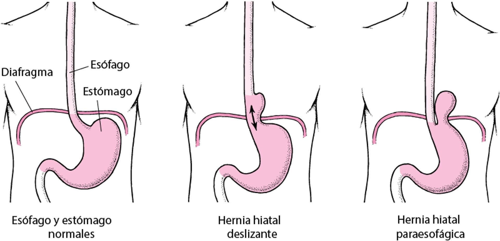 Qué es la hernia de hiato