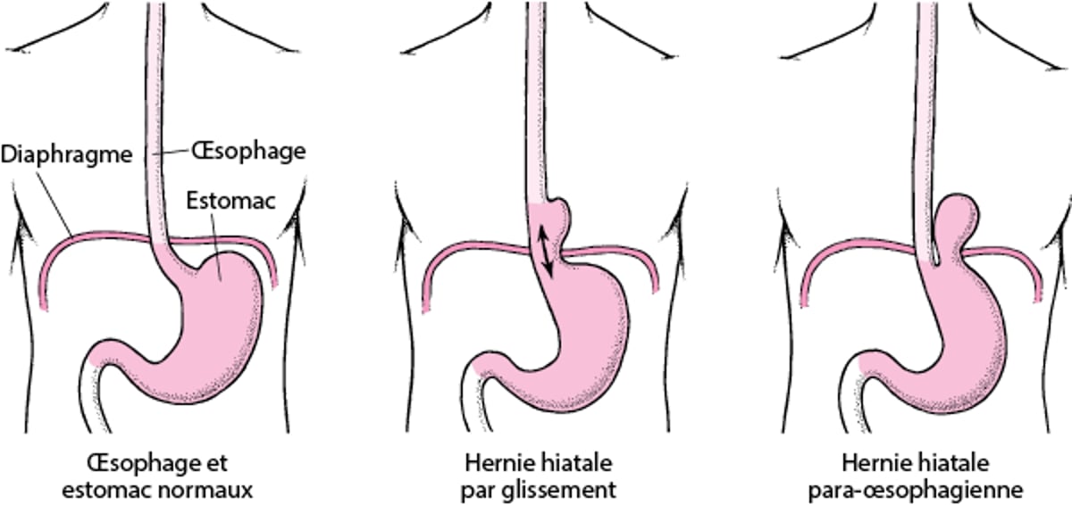 Comprendre la hernie hiatale