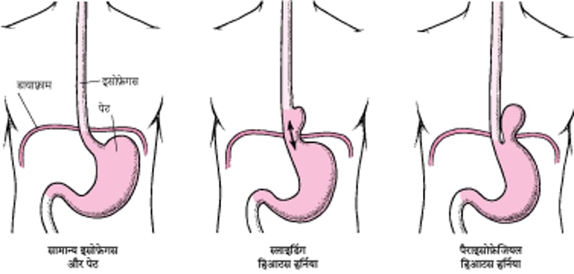 हिआटस हर्निया को समझना