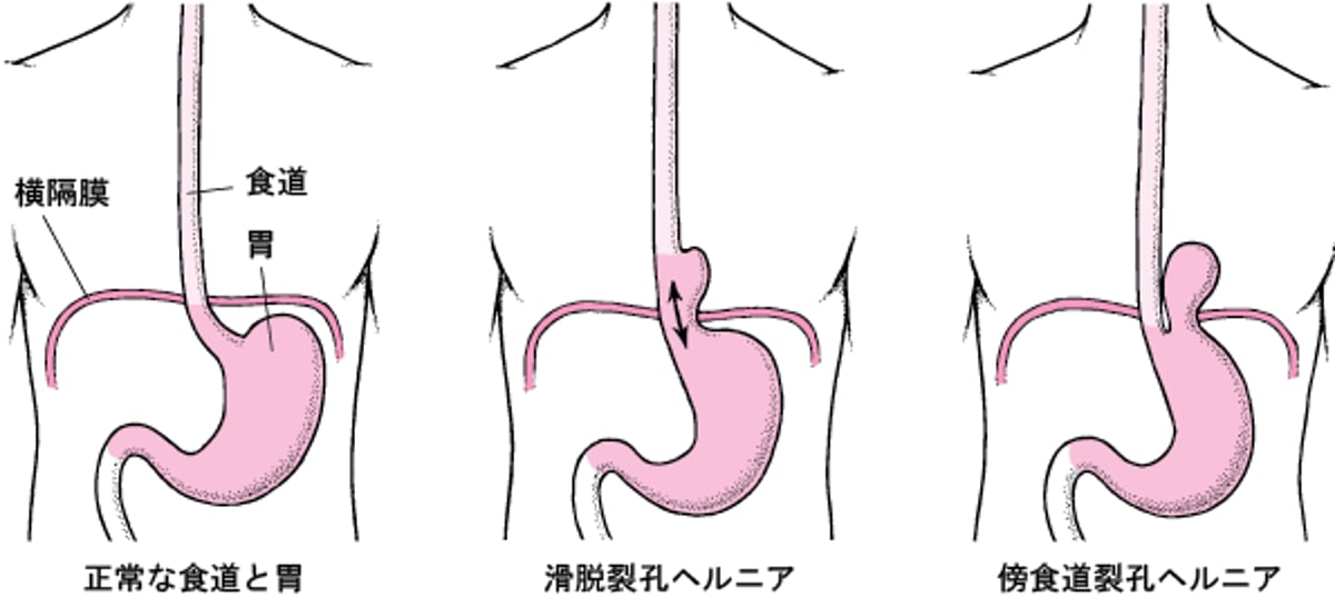 食道裂孔ヘルニアのことをくわしく知る