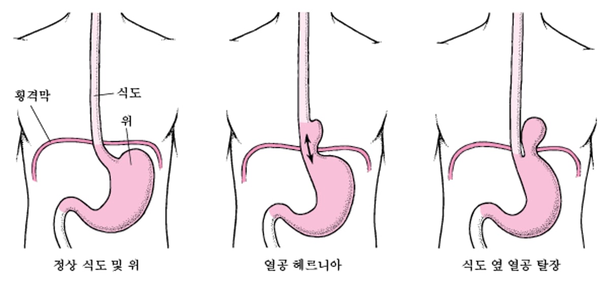 열공 탈장의 이해