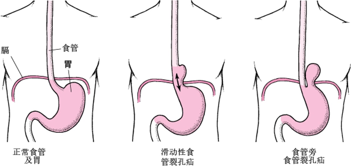 了解食管裂孔疝