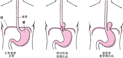 了解食管裂孔疝