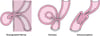 What Causes Intestinal Strangulation?