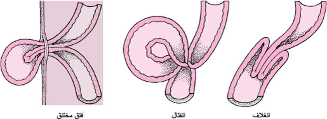 ما الذي يُسبِّبُ اختناق الأمعاء؟