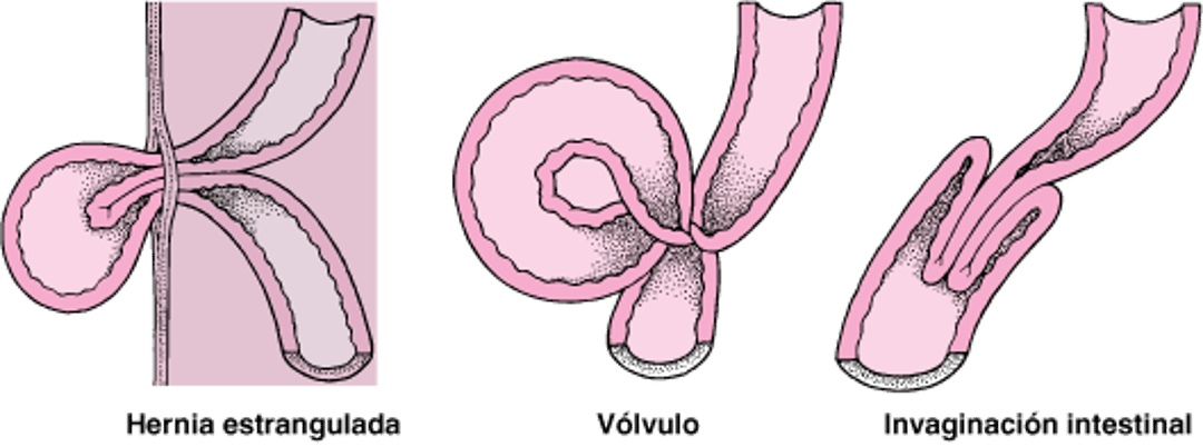 ¿Qué causa el estrangulamiento intestinal?