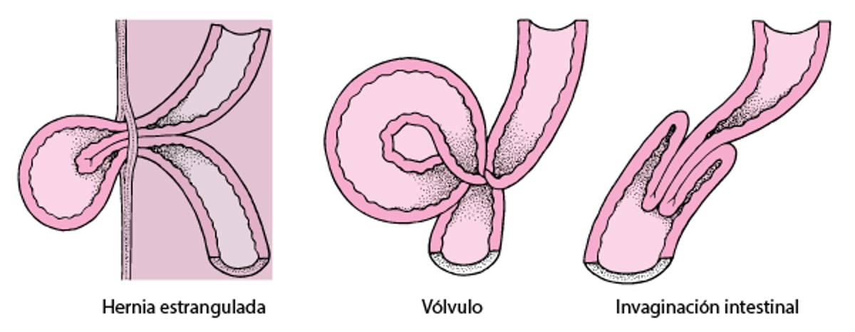 ¿Qué causa el estrangulamiento intestinal?