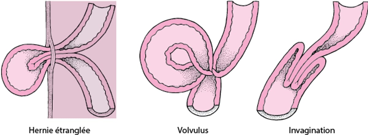 Quelles sont les causes de la strangulation intestinale ?