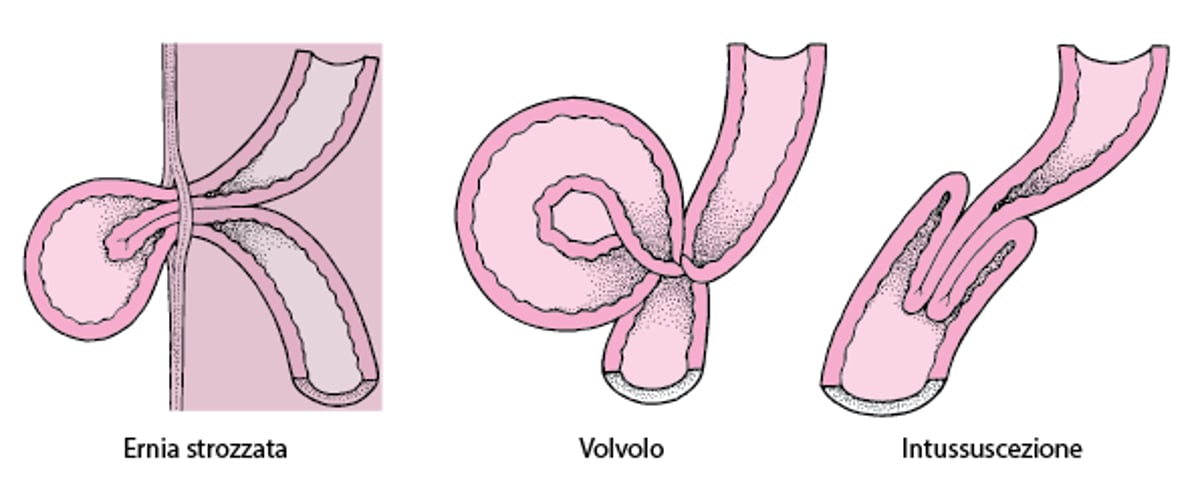Cosa determina lo strangolamento intestinale?