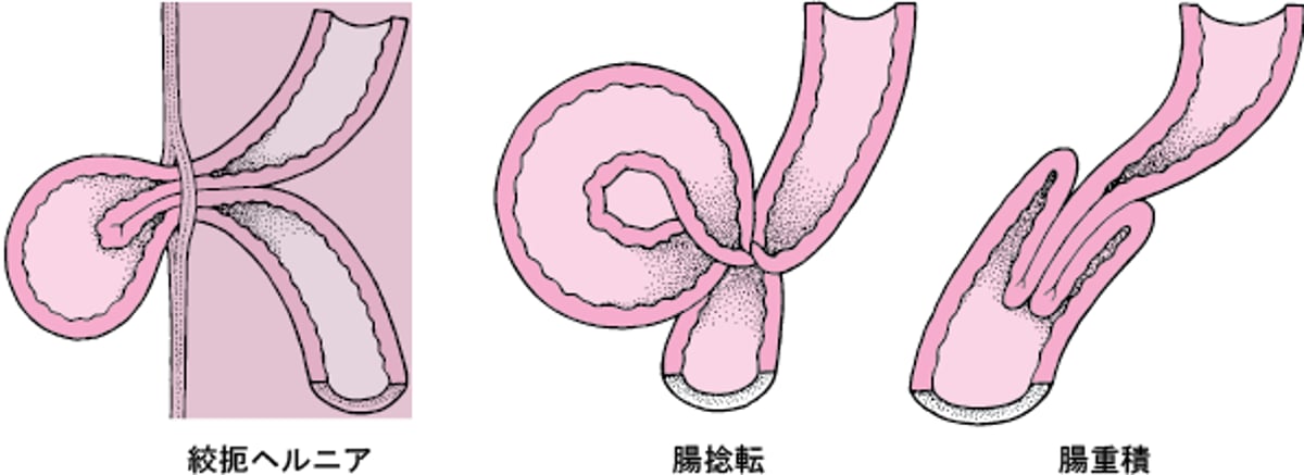 腸の絞扼の原因