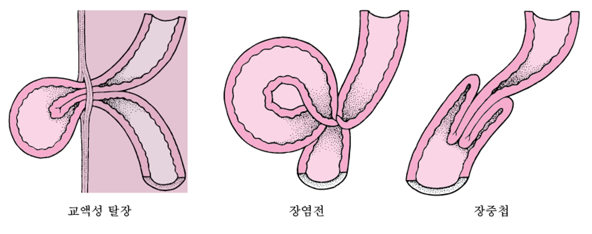 창자 조임의 원인은?