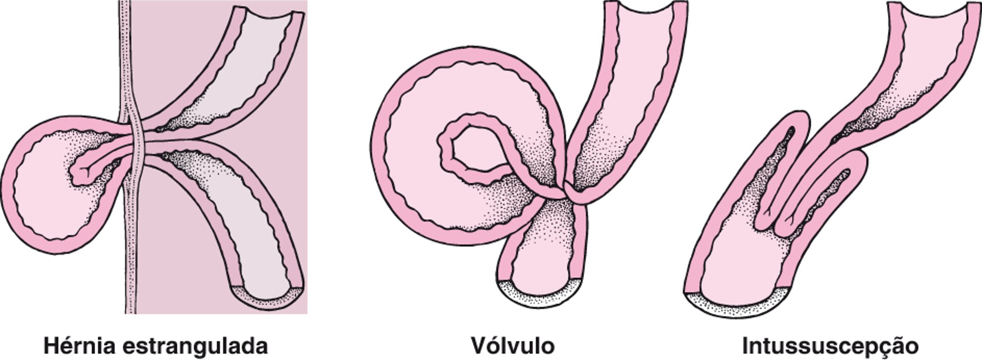 O que causa o estrangulamento intestinal?