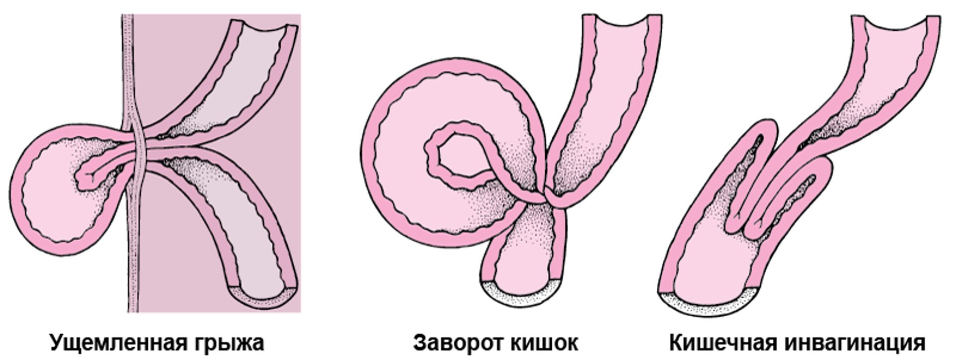 Каковы причины странгуляции кишечника?