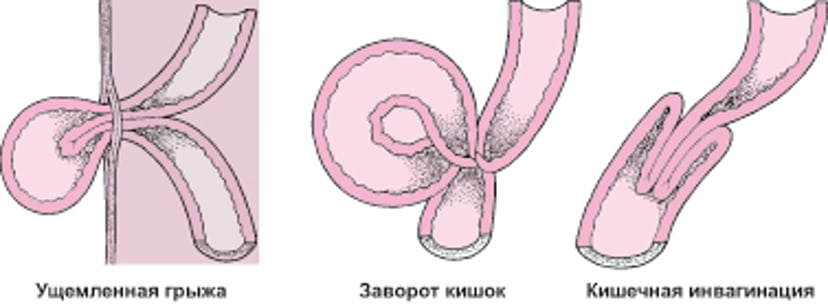 Каковы причины странгуляции кишечника?