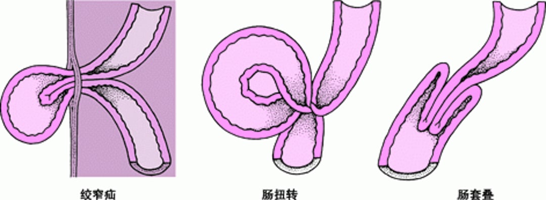 引起肠绞窄的原因?
