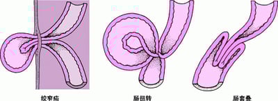 引起肠绞窄的原因?