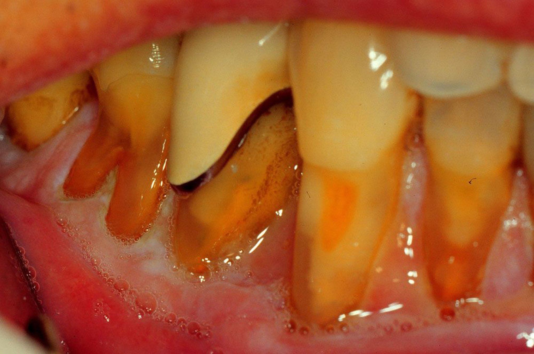歯ぐきの退縮