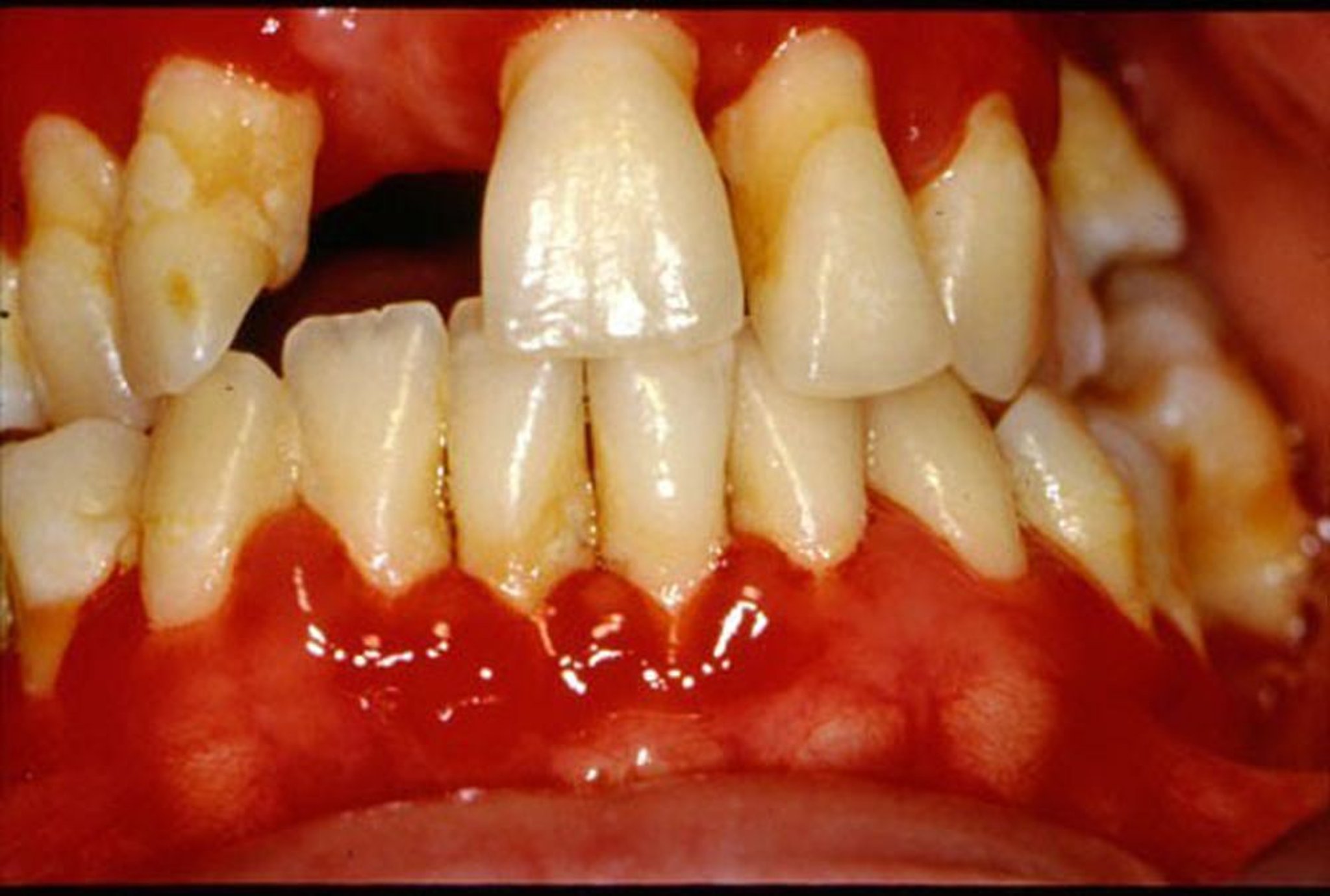 Zahnfleischentzündung (Gingivitis)