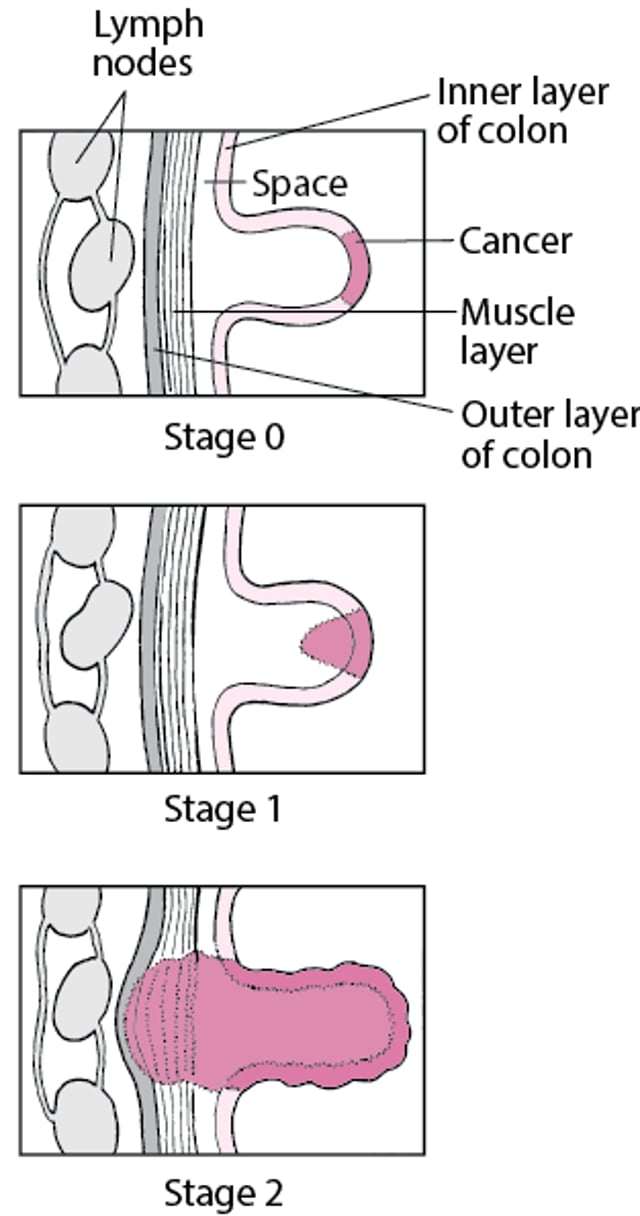 تحديد مراحل سرطان القَولون