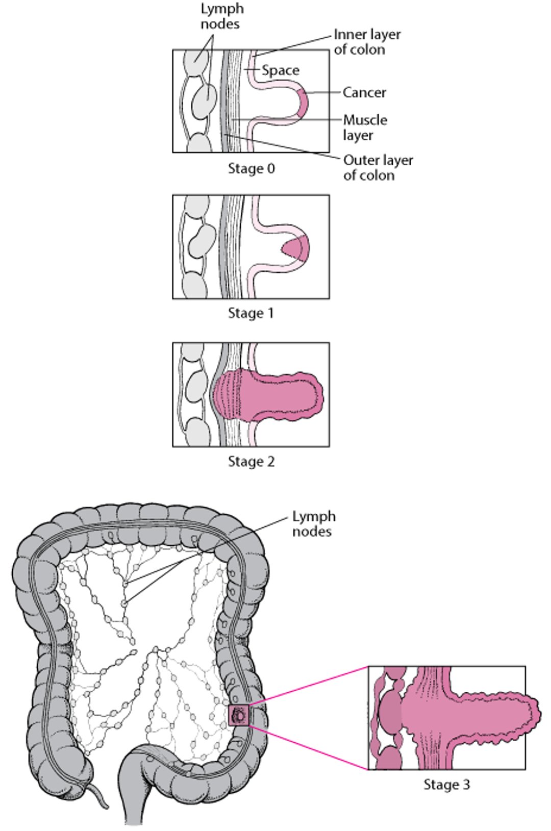 Staging Colon Cancer