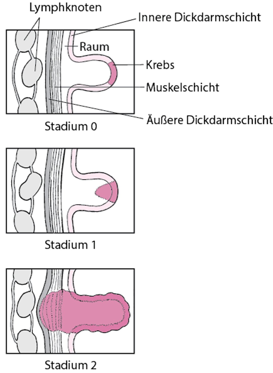 Stadien von Darmkrebs