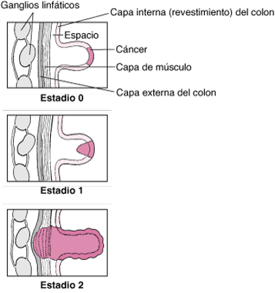 Estadiaje del cáncer de colon