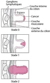 Classification du cancer du côlon